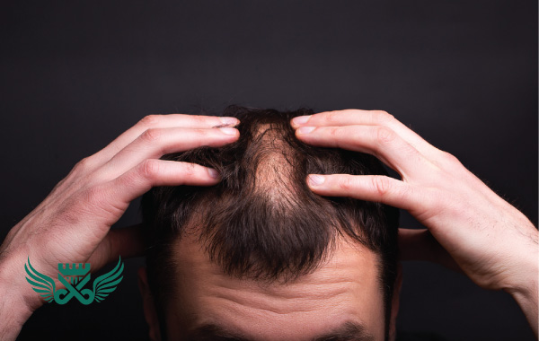 مو12 - کدام ویتامین برای جلوگیری از ریزش مو مناسب است؟